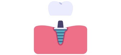 Image for Gum Implant Dental Cricut SVG Design